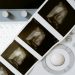 Misleading Claims About Abortion Laws